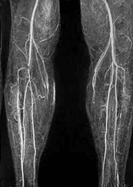 Vaskularni x -ray