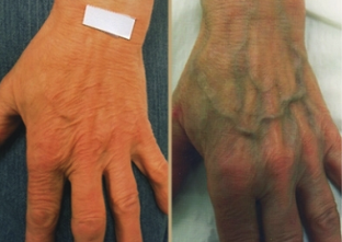 vzroki za krčne žile na rokah