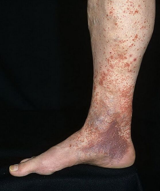 Varikozni dermatitis