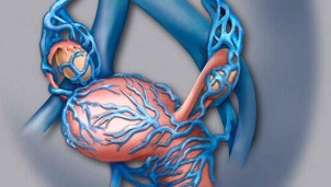 možni zapleti krčnih žil medenice
