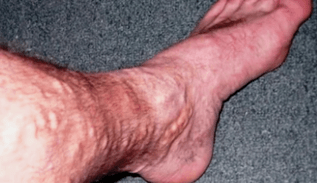 vzroki za krčne žile na nogah pri moških