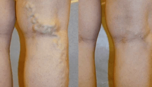 znaki in simptomi krčnih žil na nogah pri moških