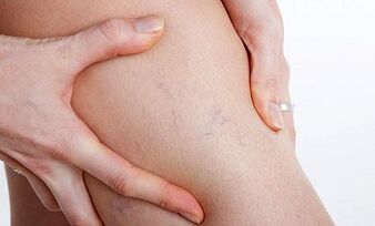 vzroki za nastanek krčnih žil na nogah