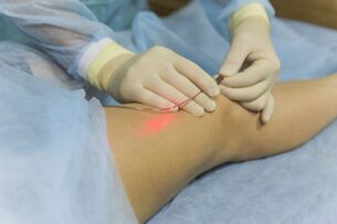 lasersko zdravljenje krčnih žil bistvo postopka