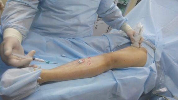 operacija za krčne žile na nogah