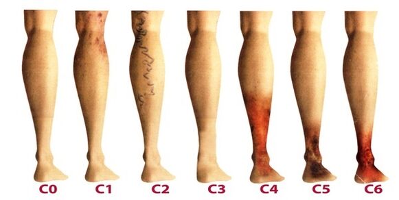 stopnje razvoja krčnih žil na nogah