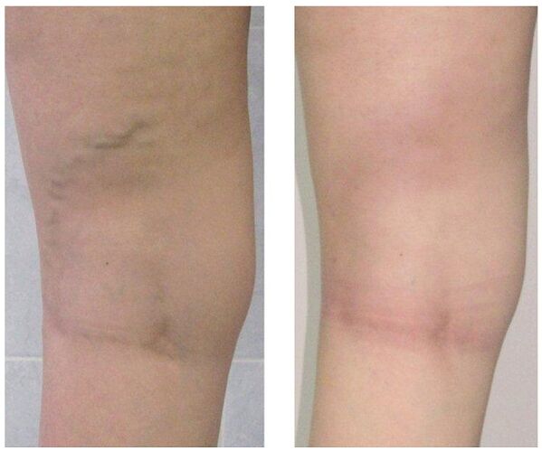 vena na nogi pred in po zdravljenju krčnih žil