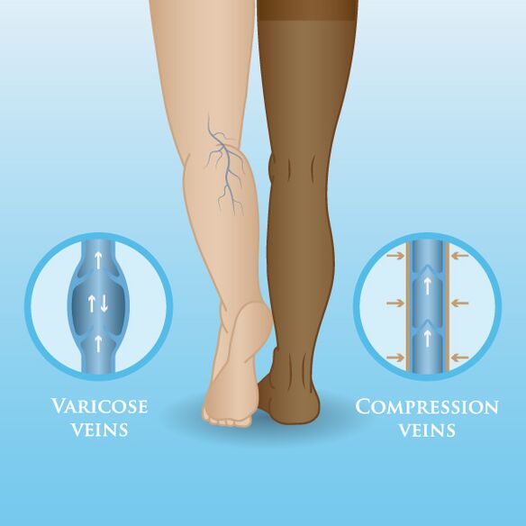 Učinki kompresijskih oblačil na krčne žile na nogah