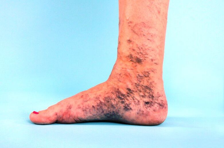 zanemarjene krčne žile na nogi