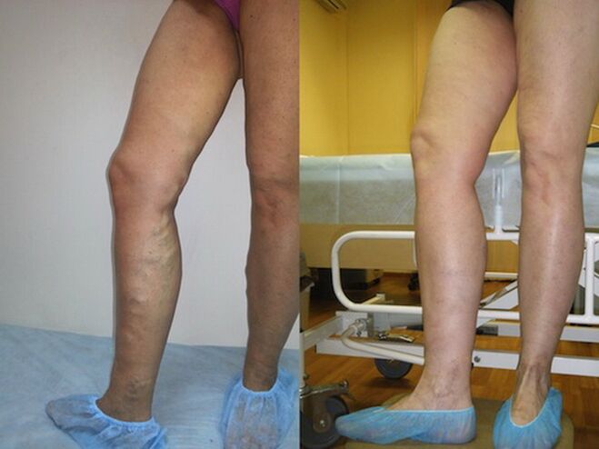 Noge pred in po laserskem zdravljenju krčnih žil