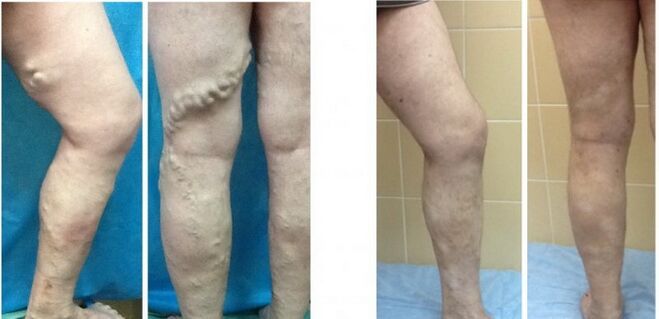 Noge pred in po radiofrekvenčni izbrisi ven s krčnimi žilami
