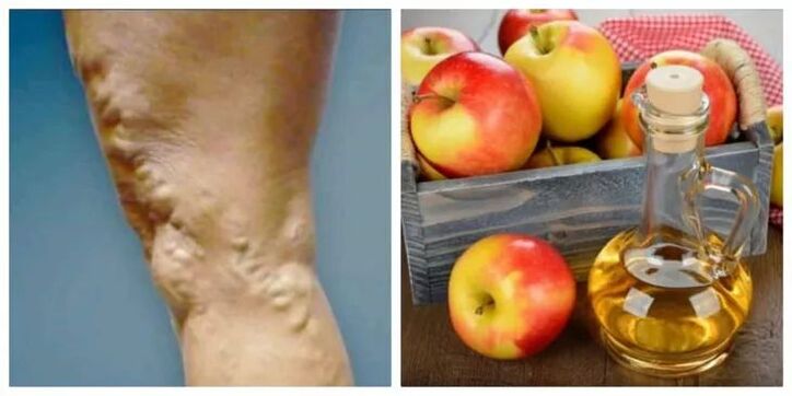 kako zdraviti krčne žile z jabolčnim kisom