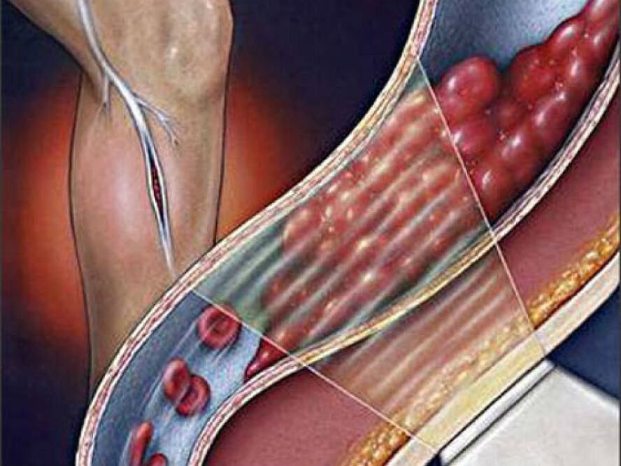globoka venska tromboza kot zaplet krčnih žil
