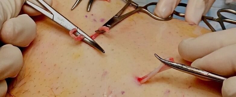 kirurško zdravljenje krčnih žil na nogah pri moških