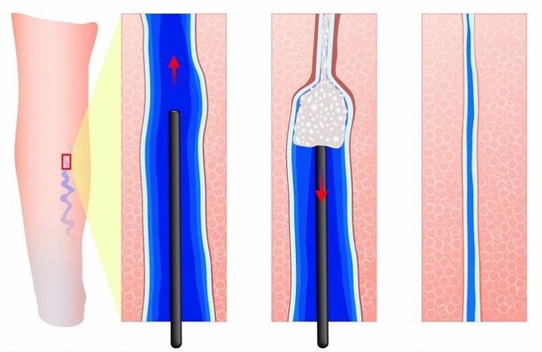 skleroterapija za krčne žile na nogah pri moških